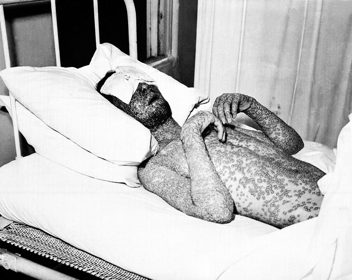 A person covered in pox on a bed.